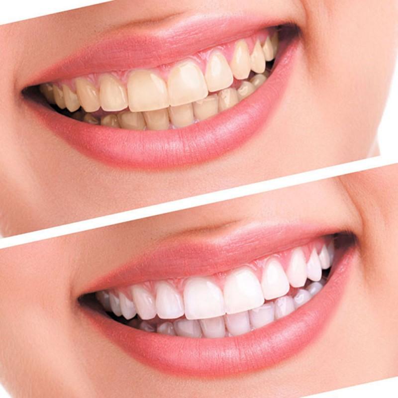 Teeth Whitening Kit Gel Set