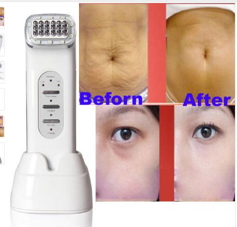 RF Beauty Wrinkle Removal Machine